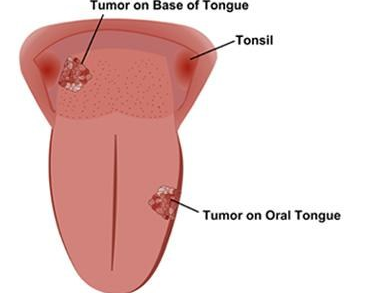 Ung thư lưỡi: Dấu hiệu nhận biết và cách điều trị