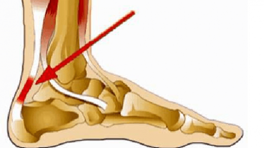 Viêm gân Achilles là gì và phương pháp điều trị hiệu quả
