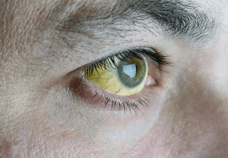 Mắt bị vàng: Nguyên nhân và cách điều trị