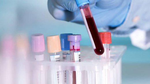 Xét nghiệm máu tổng quát là gì và các chỉ số xét nghiệm máu