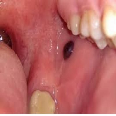 Nổi cục màu đen trong miệng