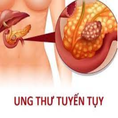 U tuỵ lành tính có nguy hiểm không