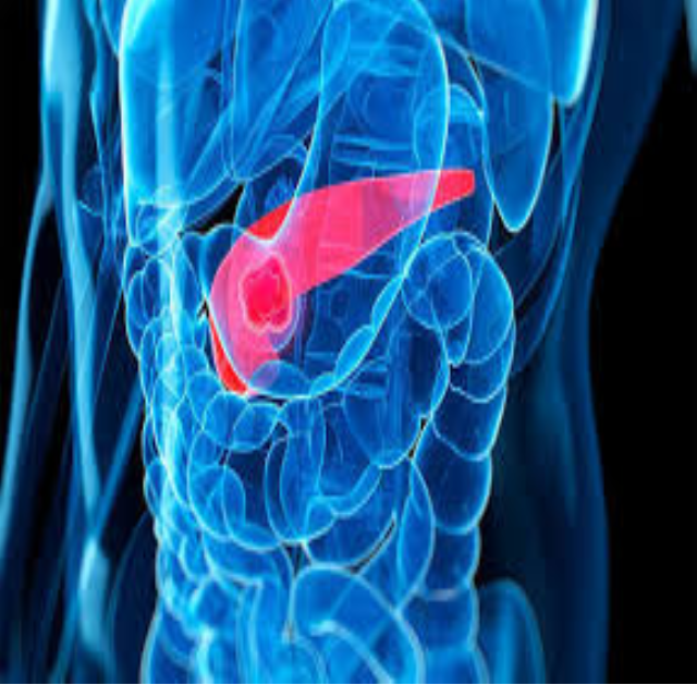 Biểu hiện của ung thư tuyến tụy