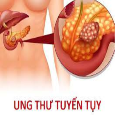 u đầu tụy