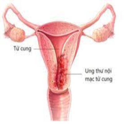Ung thư biểu mô tuyến nội mạc tử cung