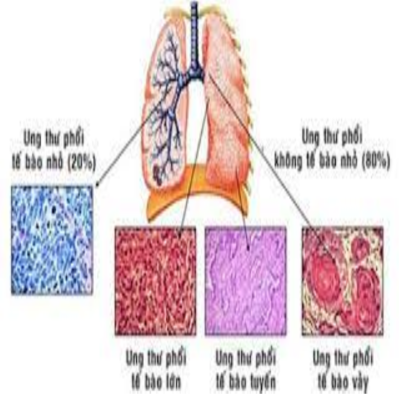 Ung thư biểu mô tuyến phế quản phổi
