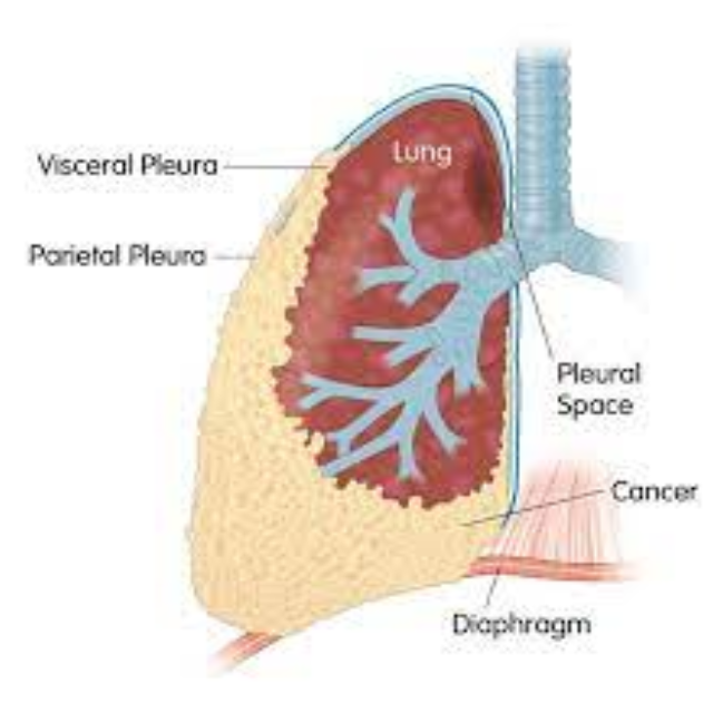 Ung thư biểu mô di căn màng phổi