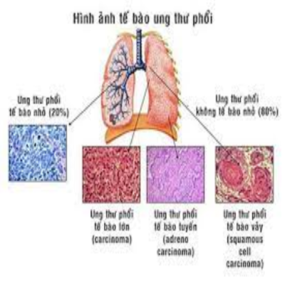 Ung thư biểu mô vảy phổi