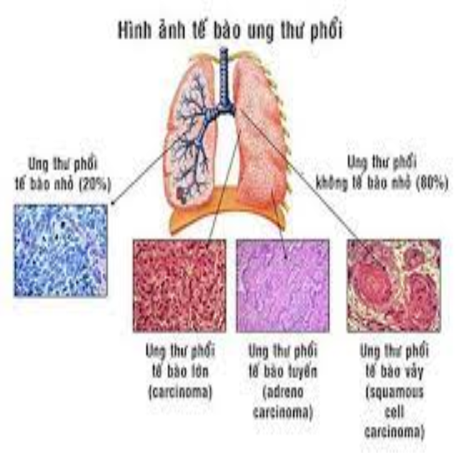 Ung thư biểu mô ở phổi