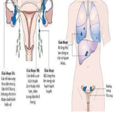 Ung thư buồng trứng giai đoạn 4 