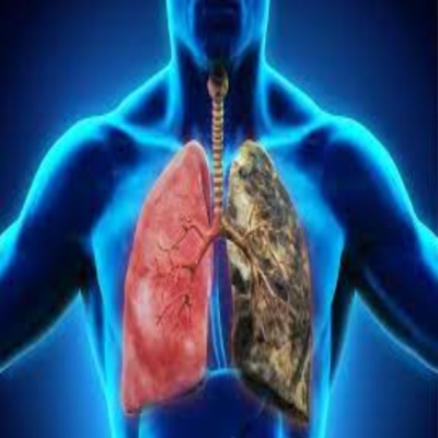 Ung thư phổi là gì 
