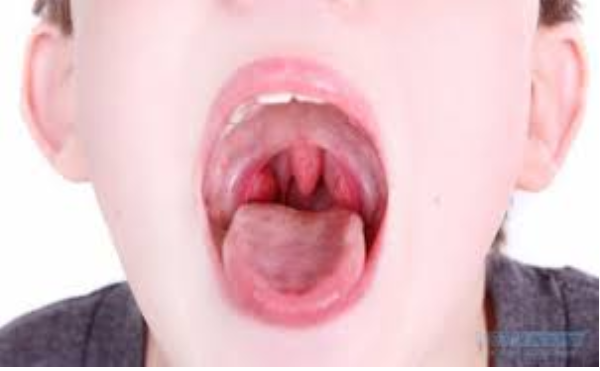Ung thư vòm họng có biểu hiện gì
