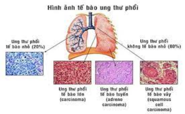 Giai đoạn ung thư phổi
