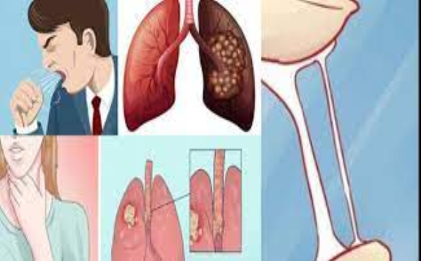 Triệu chứng ung thư phổi giai đoạn 2