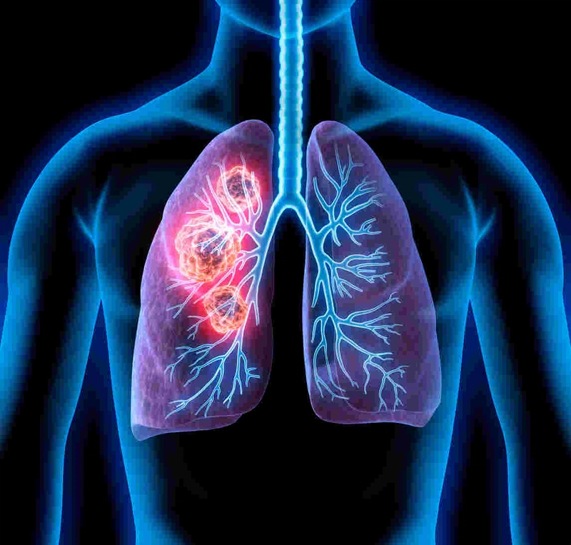Ung thư biểu mô tế bào vảy trong phổi
