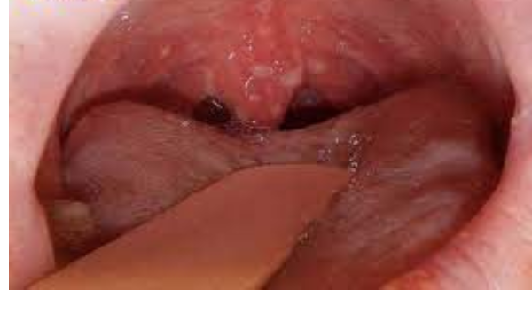 Hình ảnh ung thư vòm họng giai đoạn 3