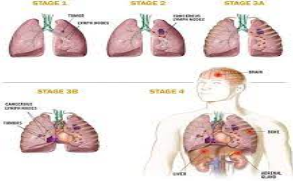 Ung thư phổi các giai đoạn