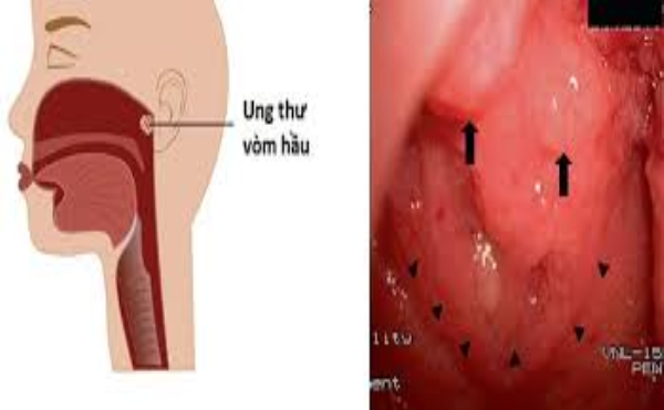 Ung thư vòm họng có ho không