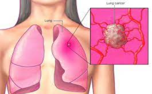 U phổi ác tính sống được bao lâu