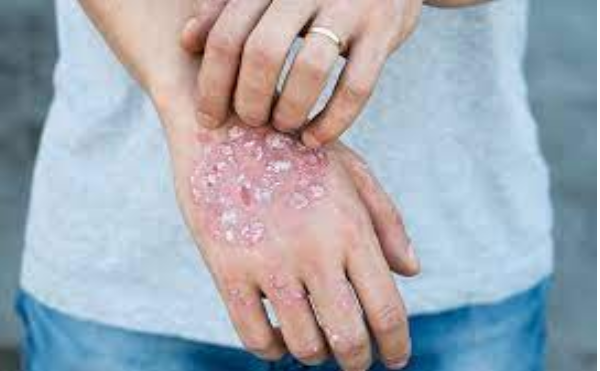 Bệnh da liễu eczema