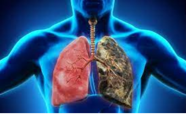 Ung thư phổi có mấy giai đoạn