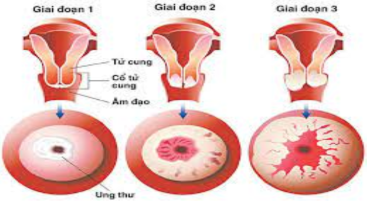 Bệnh ung thư cổ tử cung có lây không