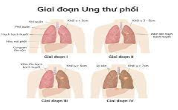 K phổi giai đoạn 4