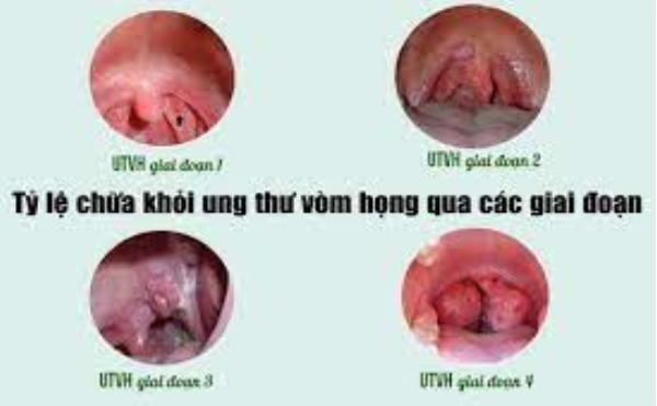 Ung thư vòm họng chữa khỏi không