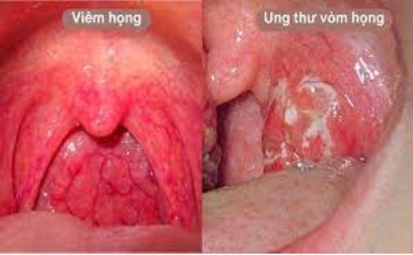 Ung thư vòm họng biểu hiện ban đầu