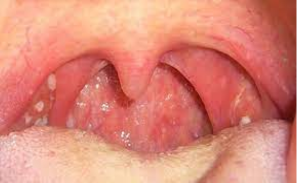 Ung thư vòm họng triệu chứng