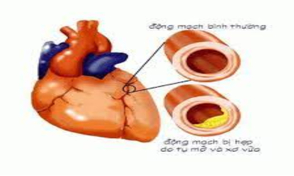 Bệnh tim do thiếu máu cục bộ